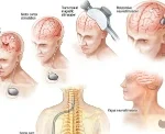 This is a feature image for blog article Neurostimulation Devices at Roots Analysis