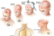This is a feature image for blog article Neurostimulation Devices at Roots Analysis