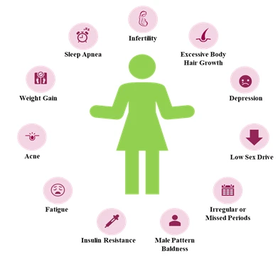 symptoms and diagnostic criteria for polycystic ovary syndrome?