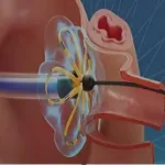 This is a feature image for blog article Pulsed Field Ablation at Roots Analysis
