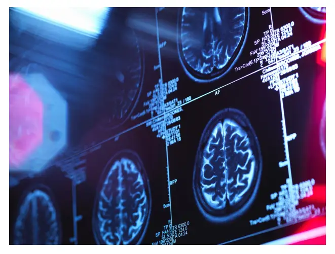 Alzheimer's Detection Unveiling the Future Breakthrough Blood Test